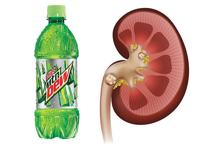 Can Mountain Dew Cause Kidney Stones (1)