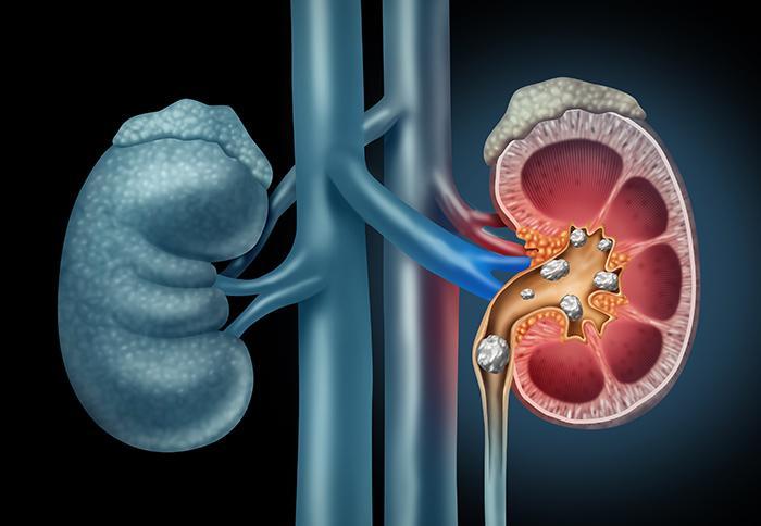 Does Liquid Iv Cause Kidney Stones (3)