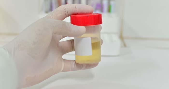Blood In Urine From Alcohol 