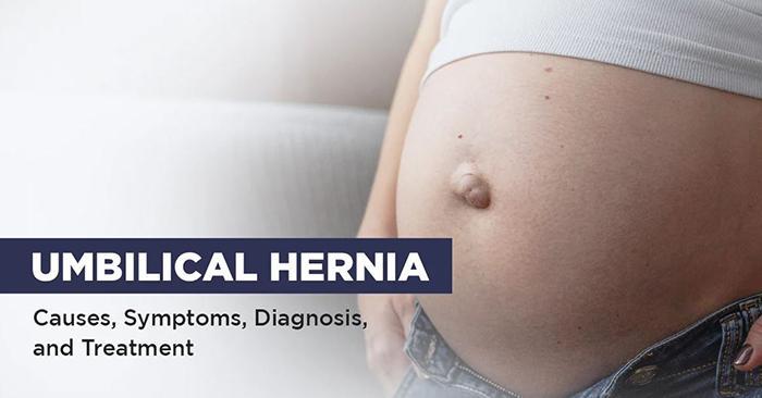 Can You Drink Alcohol With An Umbilical Hernia (2)