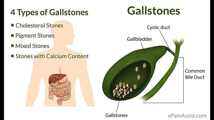 Can You Drink Alcohol With Gallstones (2)