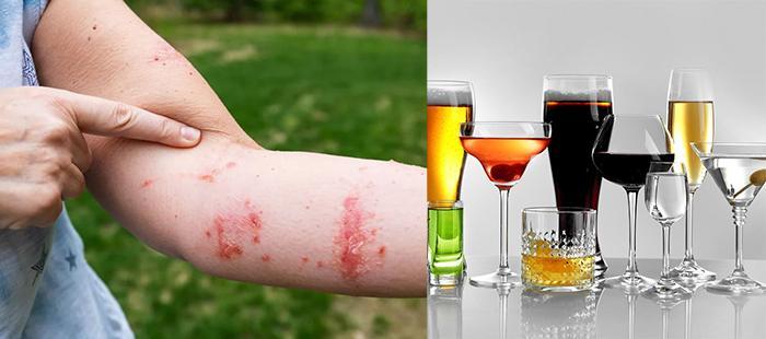 Does Alcohol Kill Poison Ivy (2)