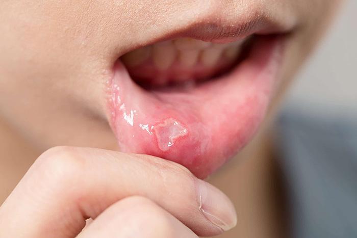 Mouth Ulcers After Drinking Alcohol (1)