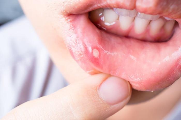 Mouth Ulcers After Drinking Alcohol (1)