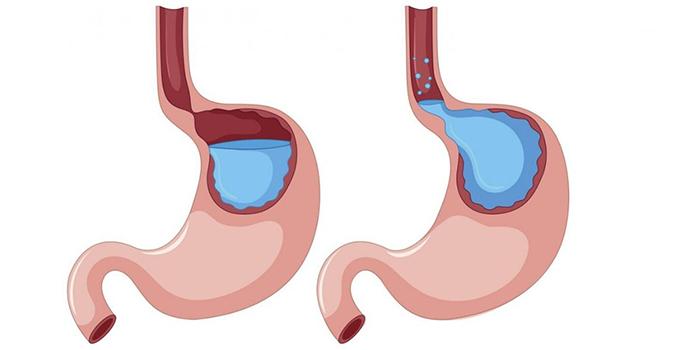 Is Kefir Good For Acid Reflux (1)